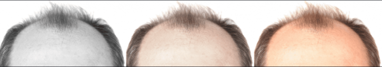 나이가 들고 세월이 지날 수록 머리카락에 힘이 없어질때 좋은 해결책은 없을까?