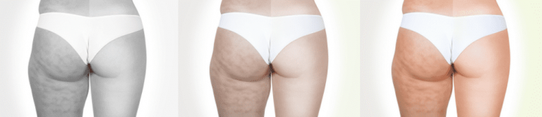 허벅지 셀룰라이트 없애는법 어떻게 해야 할까?